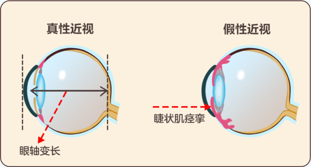 眼睛验光是怎么回事,眼睛验光参数怎么看