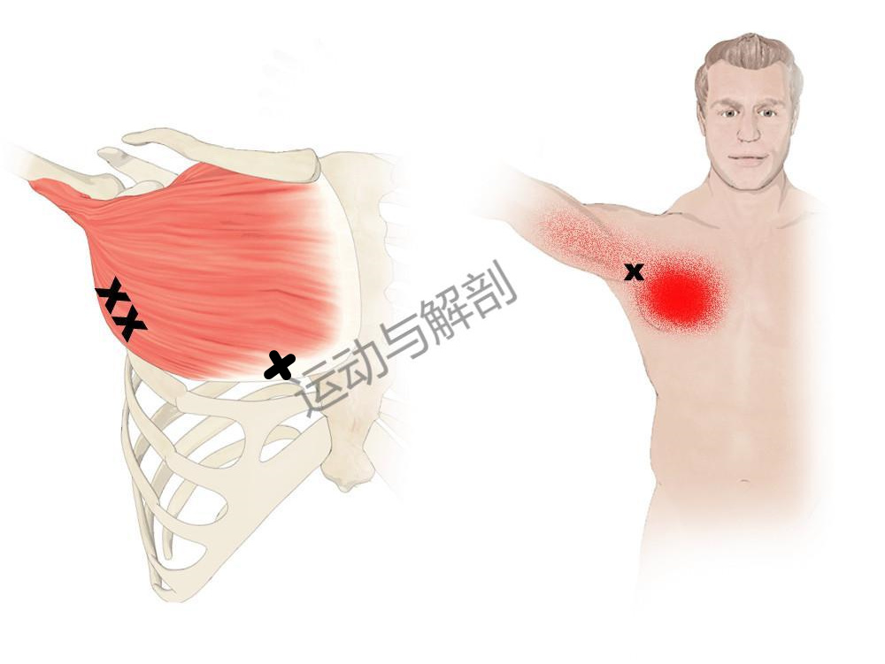 如何松解胸大肌的触发点?解决肩痛,胸痛以及手臂内侧疼痛等问题!