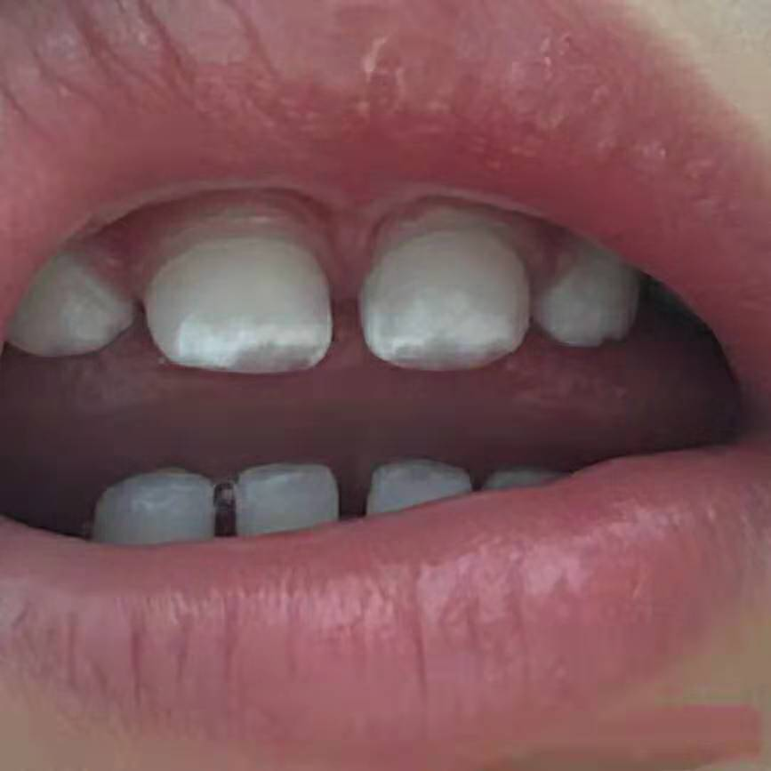 儿童专业牙膏护牙剂:宝宝牙齿上有白点,别忽视!