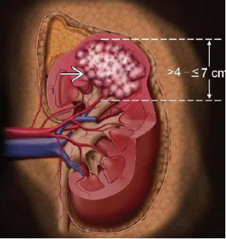 肾肿瘤分期搞不清?一文让你秒懂!
