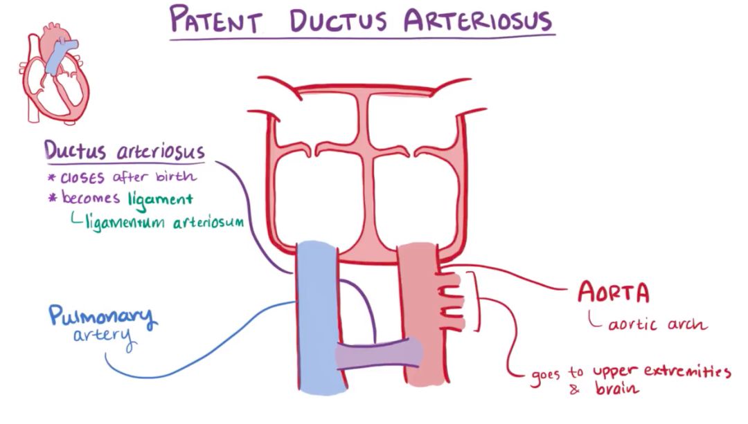 【osmosis】动脉导管未闭 patent ductus arteriosus