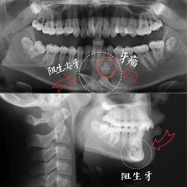 牙齿矫正(正畸)【小案例】—先天性缺牙 牙列不齐 深覆合