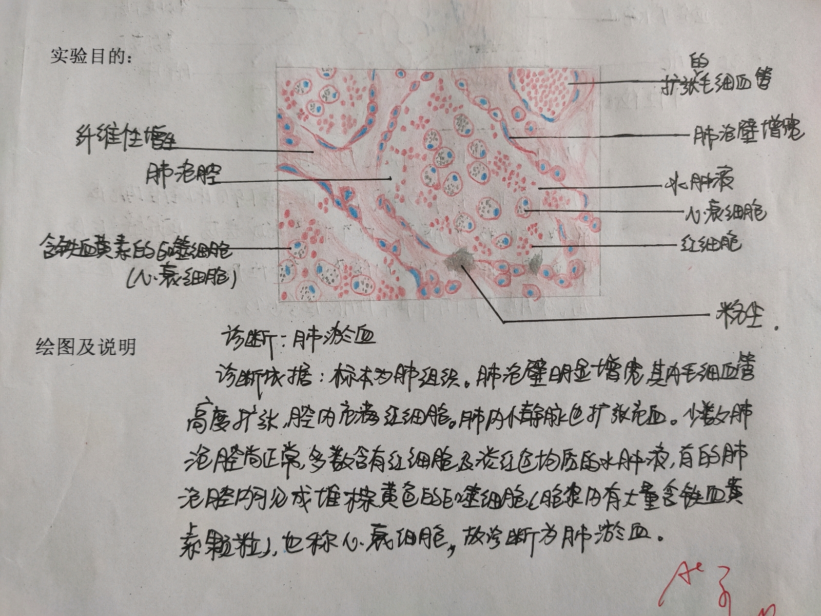 科技 学习 病理学红蓝铅笔绘图 1.皮肤高分化鳞癌 2.