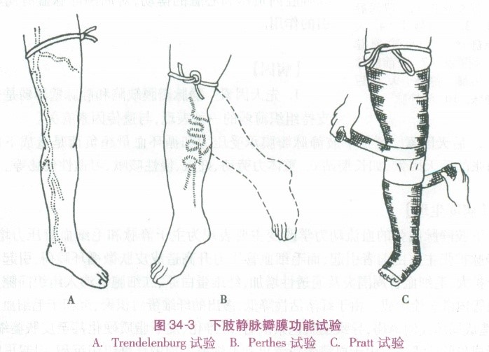 (3)交通静脉瓣膜功能试验(pratt test):病人仰卧,抬高下肢,在大腿