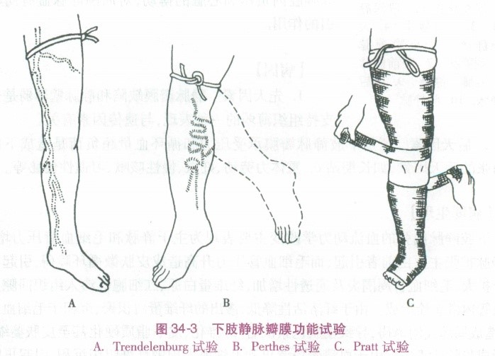 下肢静脉曲张的静脉瓣膜功能试验,你能分清吗?