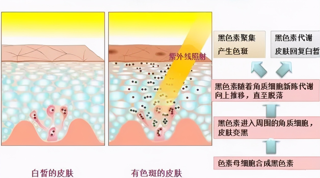 雀斑妆好看?excuse me?那是因为你还没有遇见真的斑