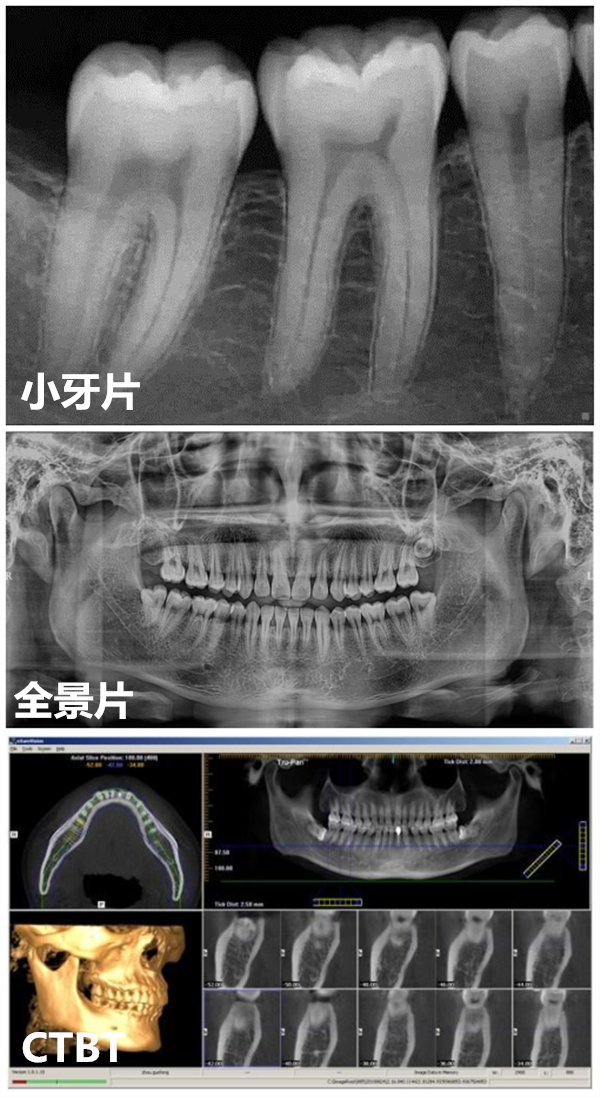 拍一次全景片的辐射量约6μsv,拍一次口腔ct 的辐射量约36～270μsv