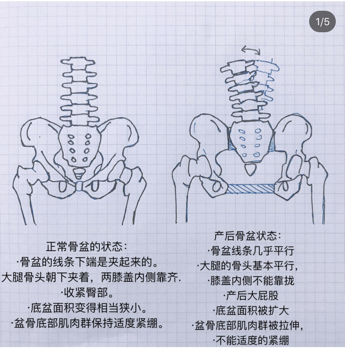 正常盆骨耻骨分离没那么夸张.大概10mm