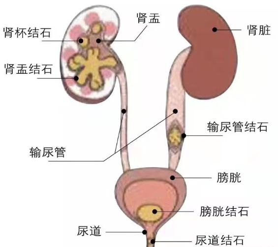 肾结石疼痛的无奈,这种疼痛就像一种酷刑一样