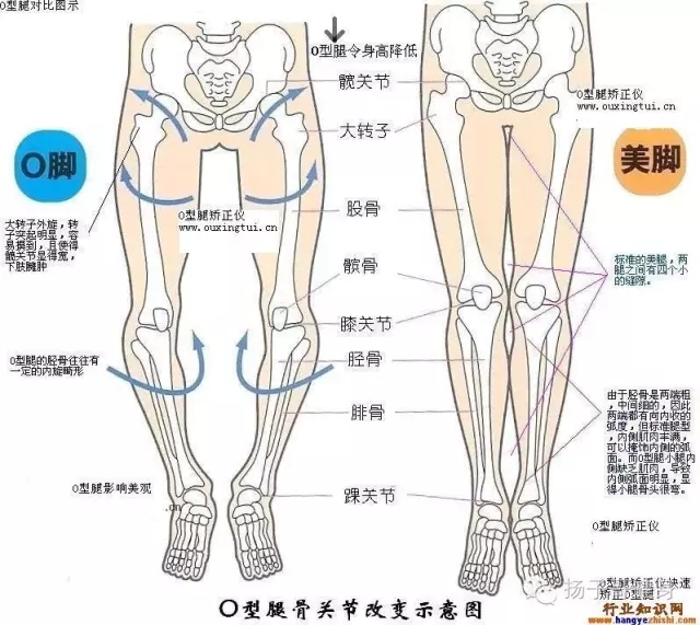 你的o型腿可以合起来了吗?