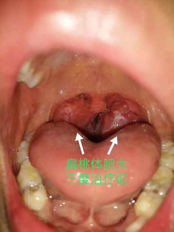 分享扁桃体肥大的症状和治疗方法!