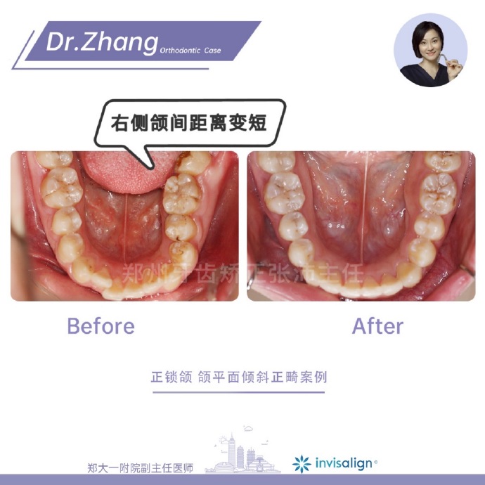 郑州牙齿矫正张沛正畸案例集正锁颌颌平面倾斜正畸疑难案例隐适美矫正