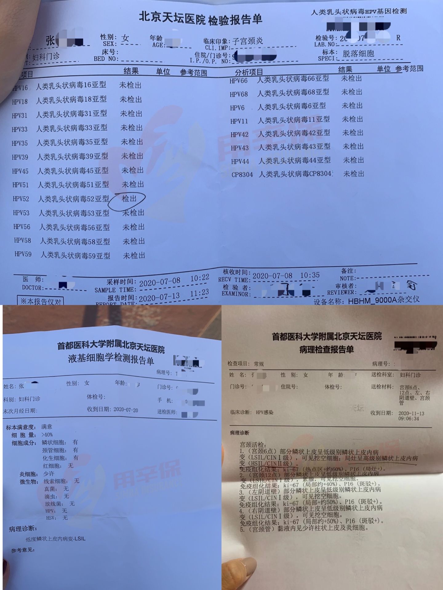 张女士的检查结果显示:hpv52阳性,tct低度鳞状上皮内病变,活检cinⅡ