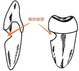 您的牙齿损坏可能是您亲手刷坏的