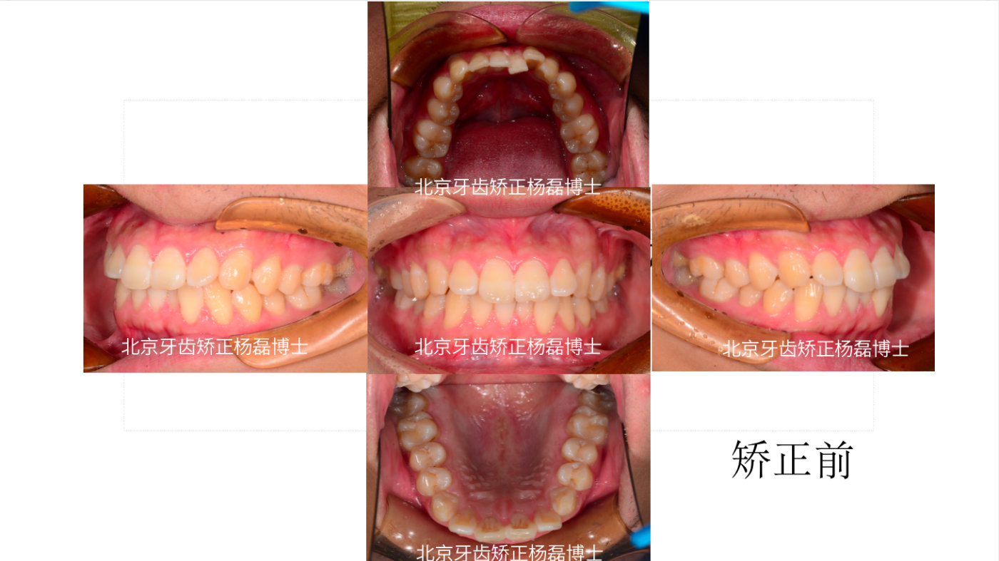 叩诊,松动度 牙弓:对称性;宽度:狭窄;中线:对正 牙龈牙周:口腔卫生