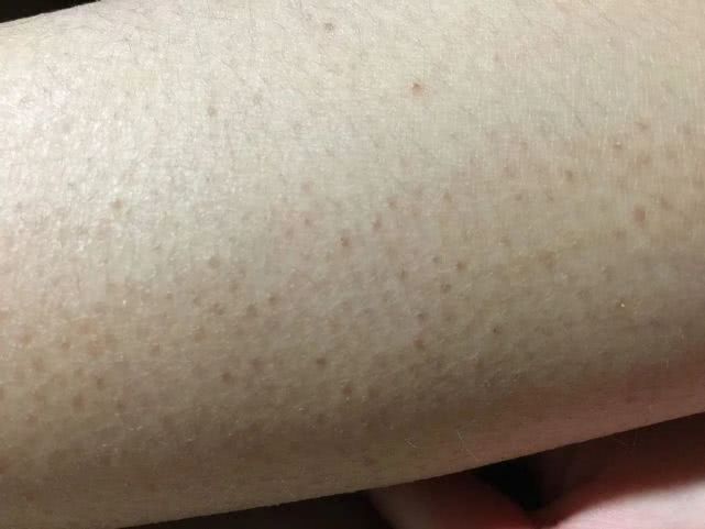 「鸡皮肤」其实是一个非常形象的称呼,它疙疙瘩瘩的样子非常像我们在