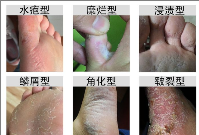 什么是脚气 脚气属于真菌感染,一般引起脚气的大多数都为红色念珠菌