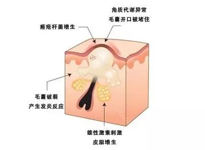 高颜值的你怎能被痘拉低分数