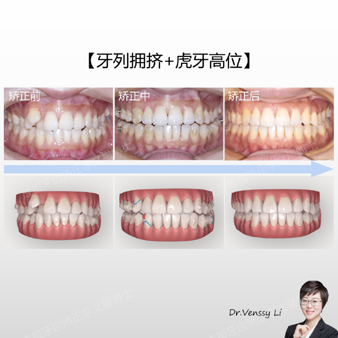 成都牙齿矫正李文星正畸案例集老虎牙如何牵引入牙弓非常规拔牙矫正