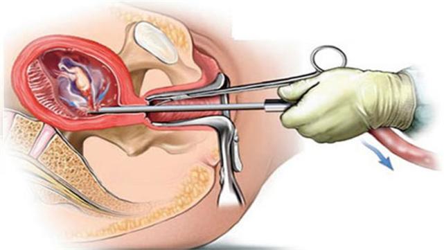 做完流产手术多久来月经,女性的朋友