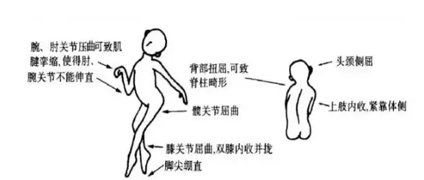 徐文娜医生看脑瘫怎么样？