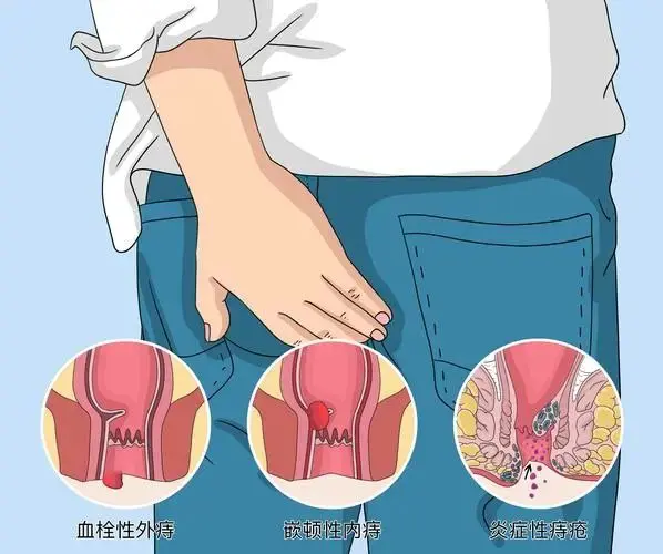 大便时用力拉出血？痔疮在什么情况下需要手术？