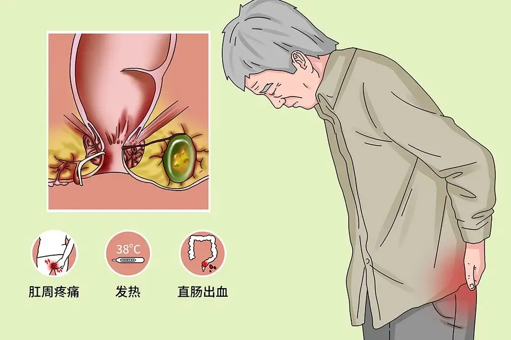 出现这几个症状，很可能已中了"肛瘘"的招?