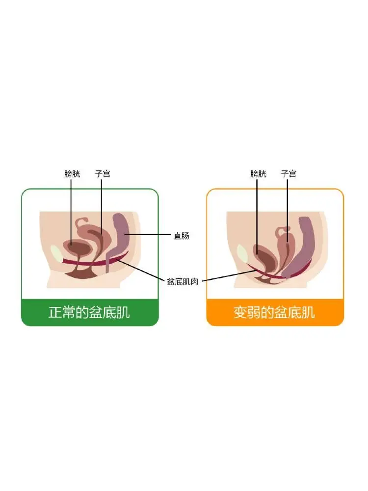 盆底肌修复千万不要“留”到二胎后做！