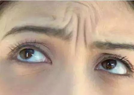 面部出现抬头纹,川字纹,鱼尾纹等皱纹怎么办?
