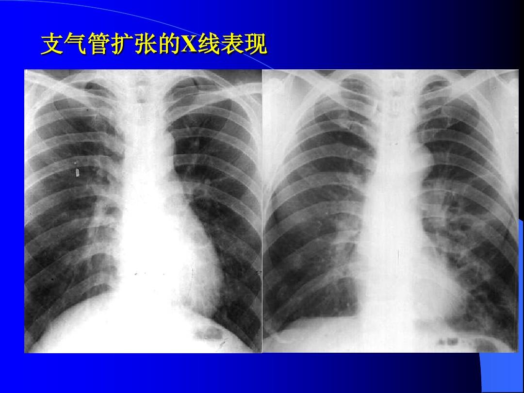 是什么导致34岁的他患上了支气管扩张?