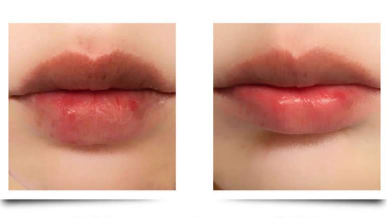 嘴唇大怎么才能变小不做手术的自然方法