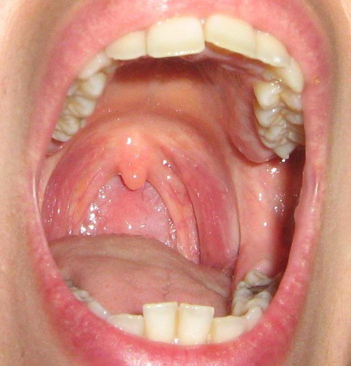 下图 a healthy throat:健康咽喉 laryngitis:喉炎 pharyngitis:咽炎
