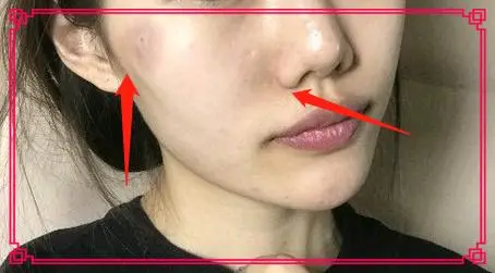 what？线雕手术后能摸到线、线雕提升后恢复过程图、敢看吗？