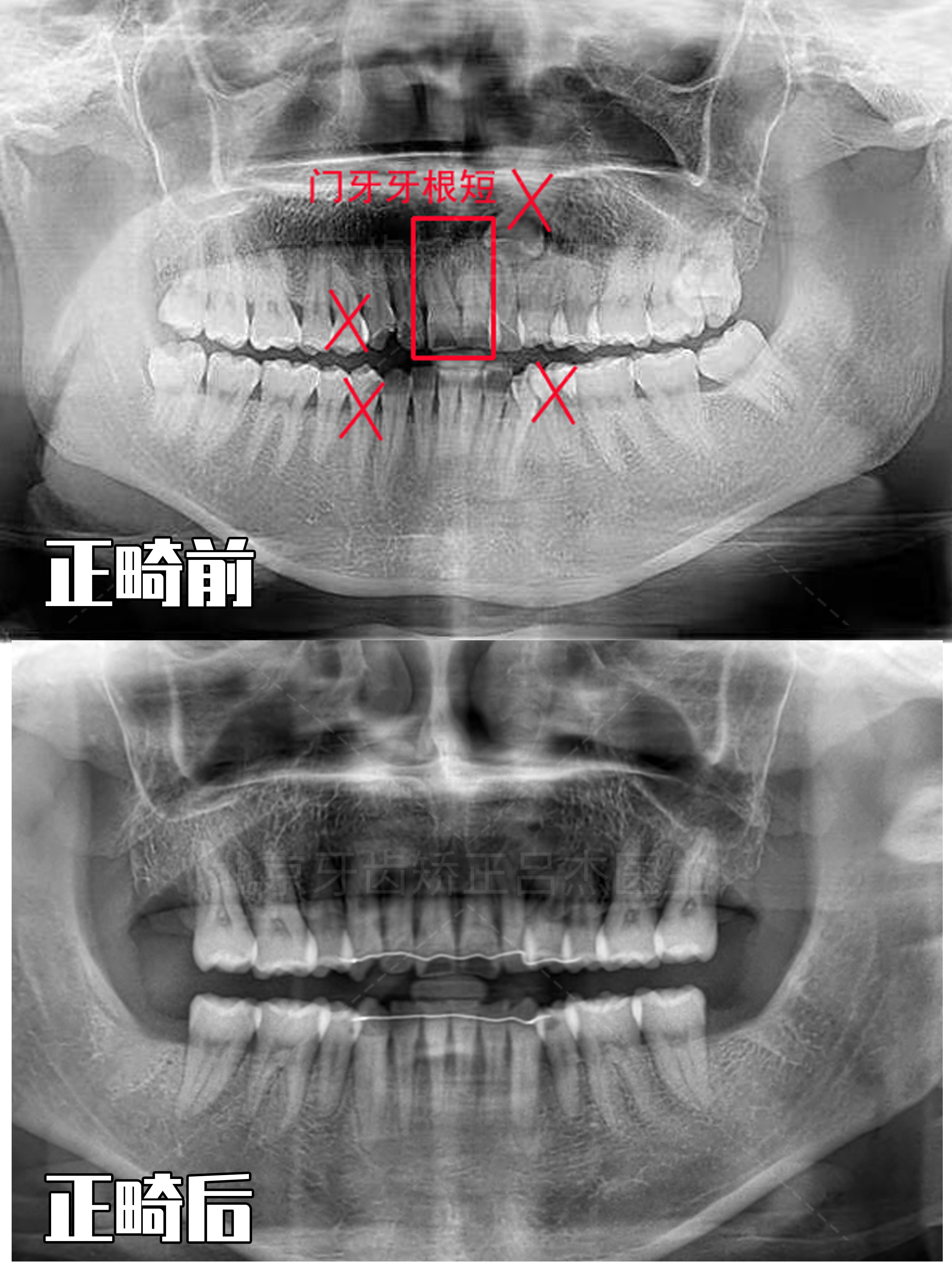 北京牙齿矫正吕杰医生案例分享门牙牙根短左上虎牙高位阻生中线右偏笑