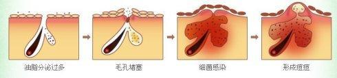 "痘痘"产生原因