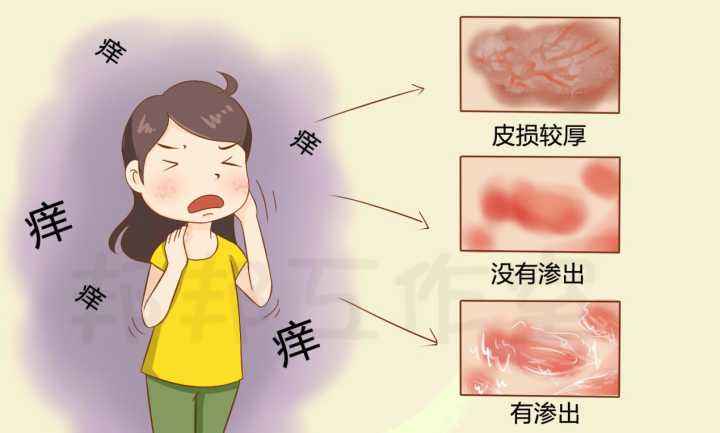 湿疹皮炎瘙痒难忍该怎么快速止痒龙脑冰皇