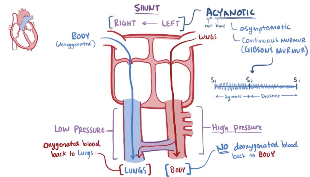 【osmosis】动脉导管未闭 patent ductus arteriosus