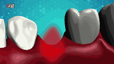 我的种牙经历(经验贴)(附消费清单)