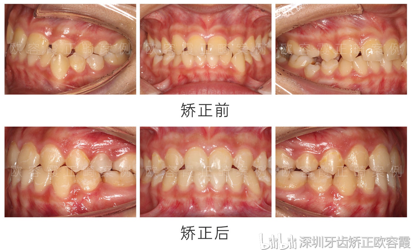 正畸前后口内照对比