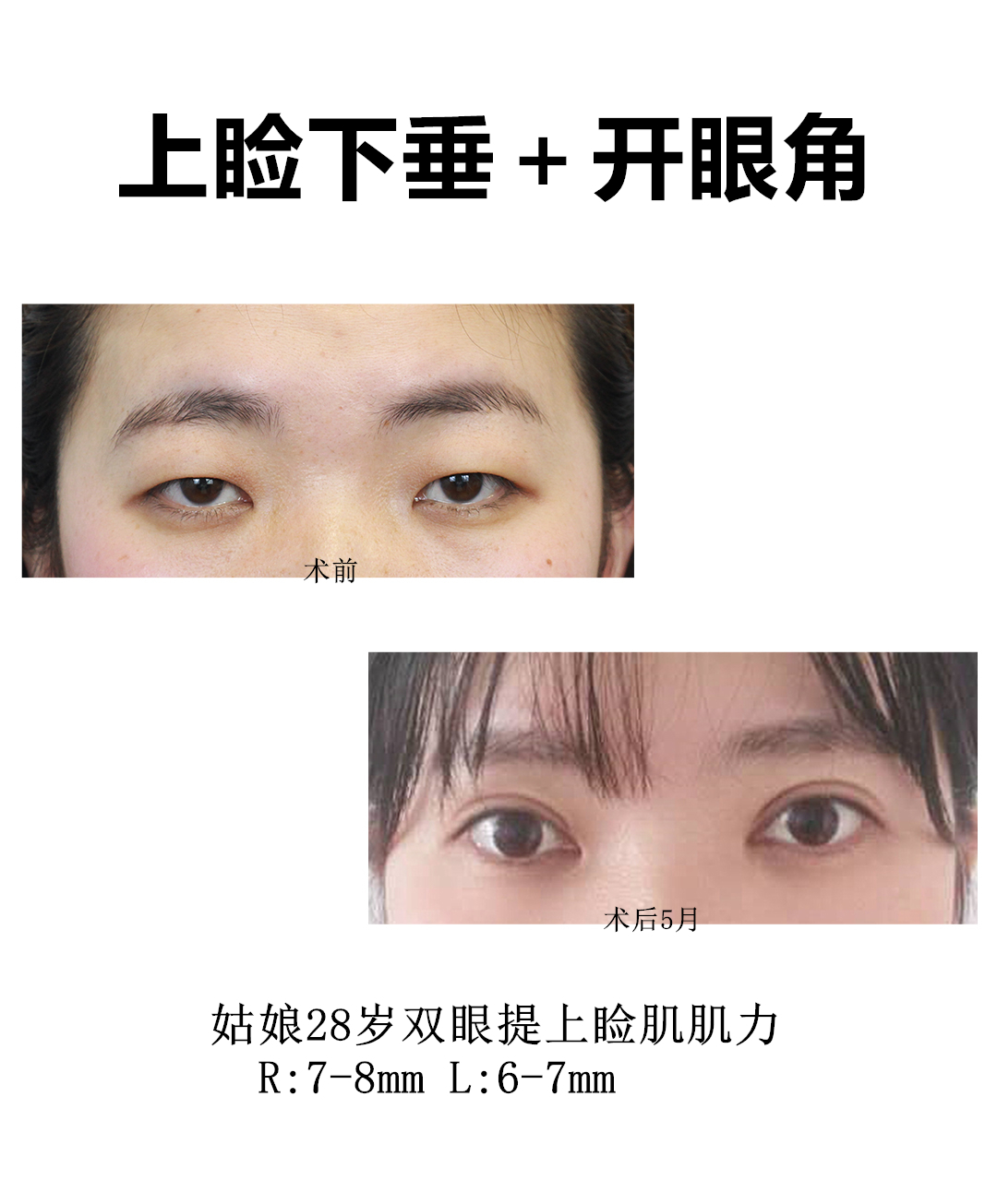 中度上睑下垂矫正