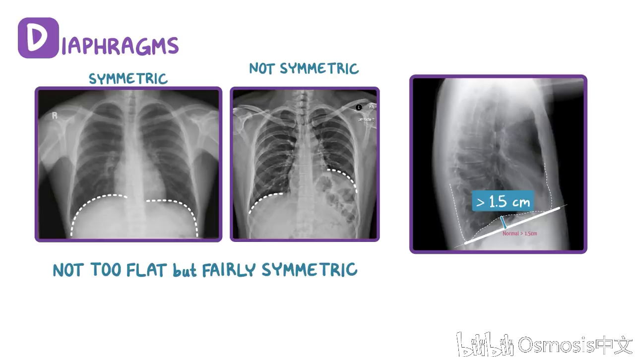 【osmosis医学】胸片判读 reading a chest x-ray