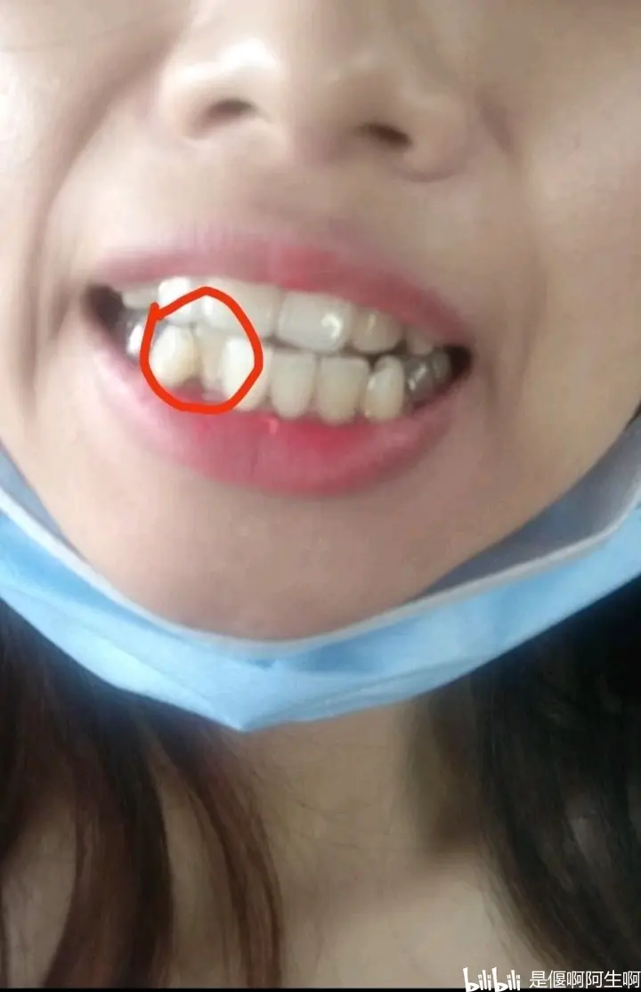 谁说隐形牙套效果比钢牙慢的!我第一个不同意!!!