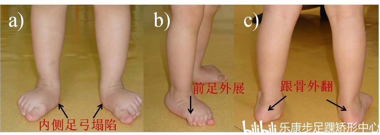 女童只因早学步两个月,却花几年时间治疗足外翻—医生提示:早学步的