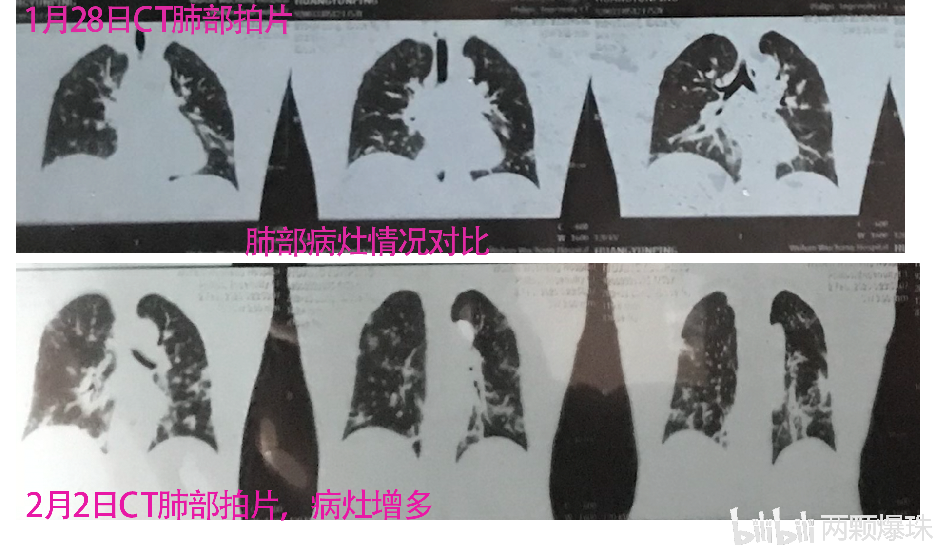 两次ct肺部对比图