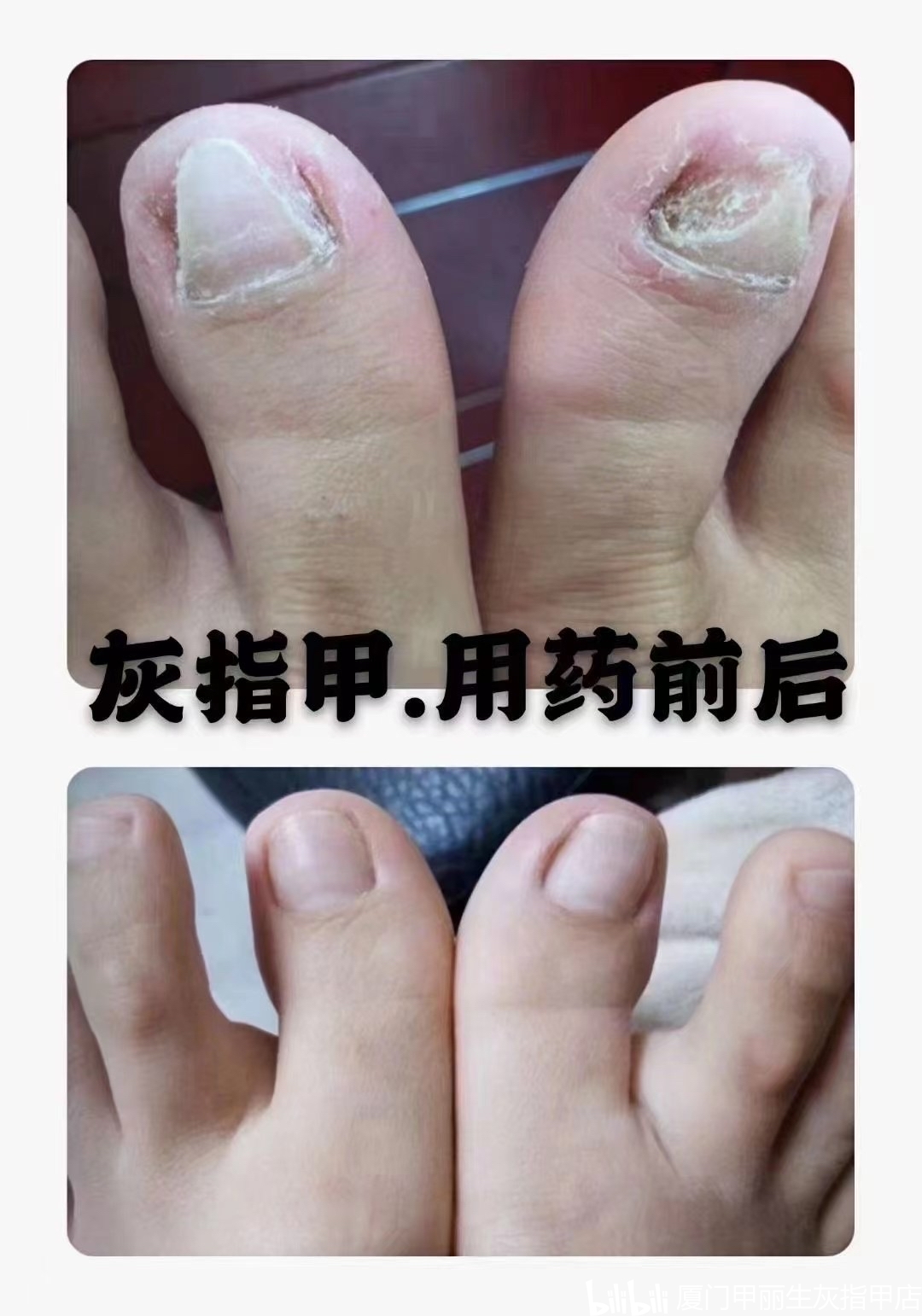 灰指甲治疗前后对比图