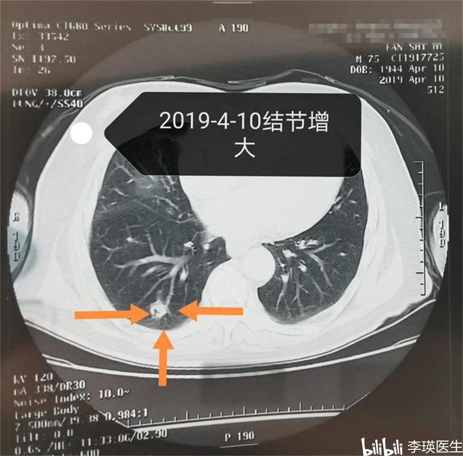 医生教你如何鉴别磨玻璃结节是良性还是恶性这种肺部结节最危险