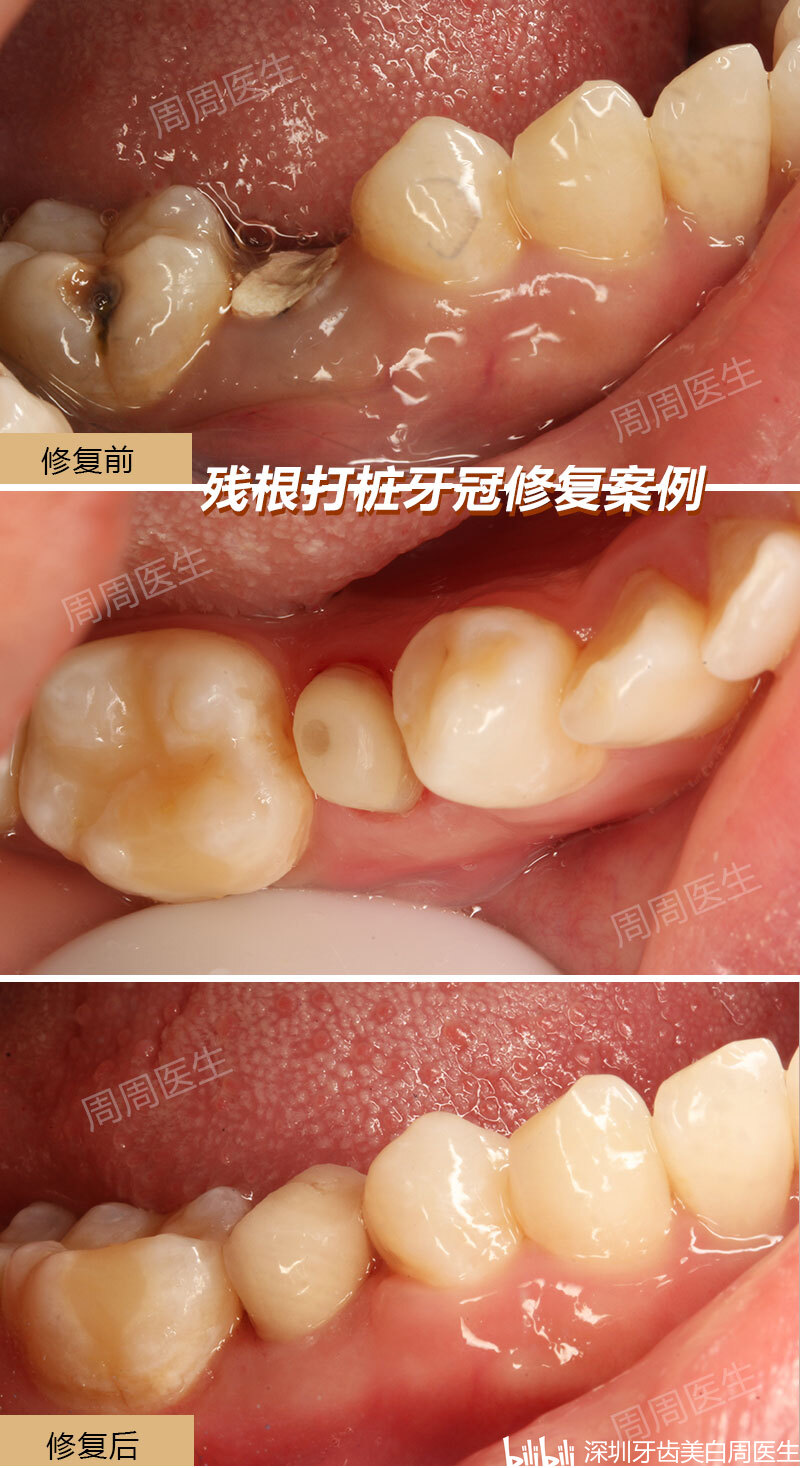 先进行根管治疗,之后再进行桩核冠修复.