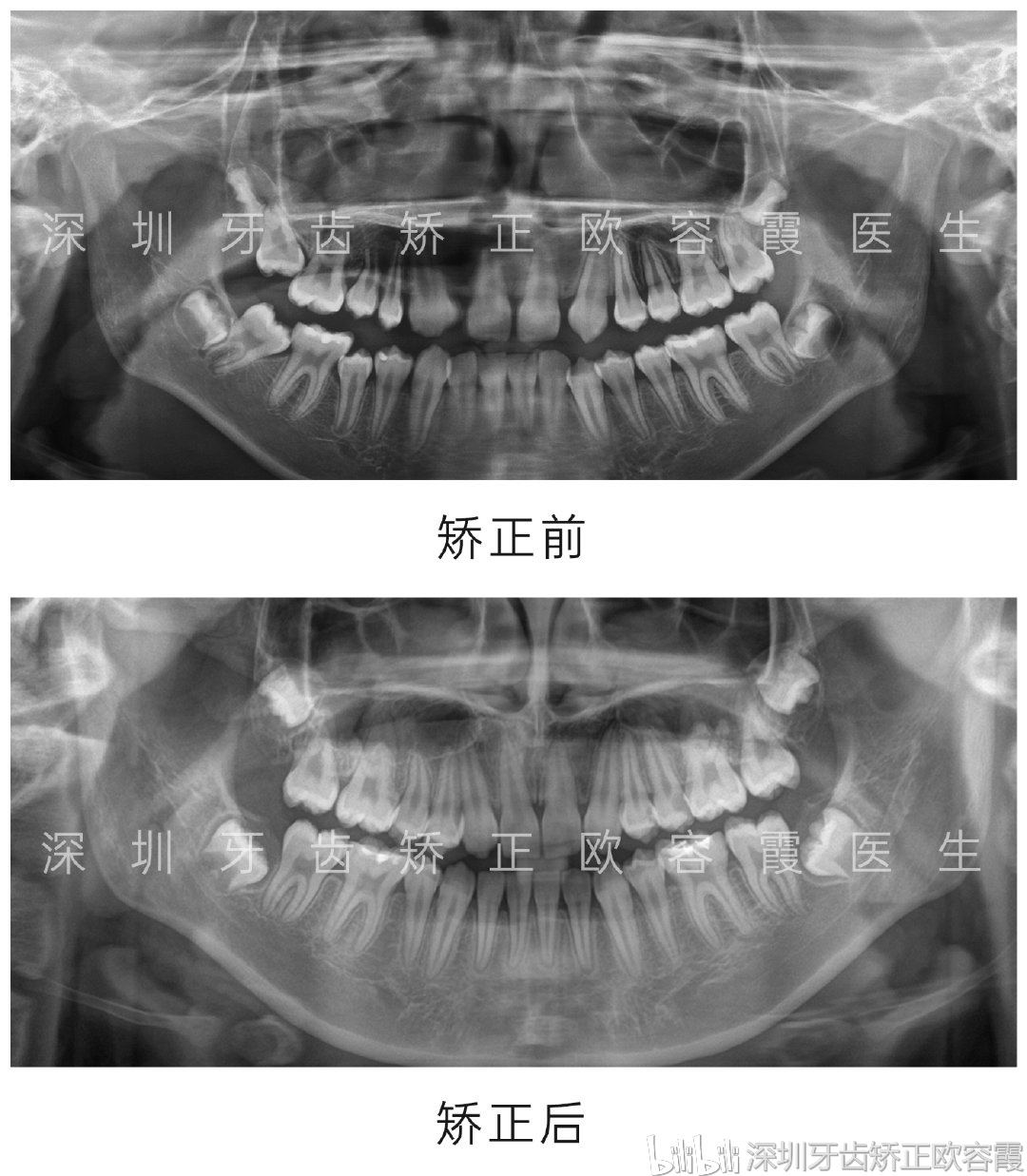 深圳牙齿矫正│上颌先天缺失侧切牙,下颌拥挤的正畸案例