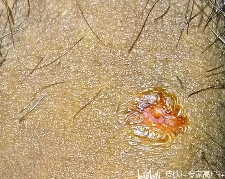 下面起包 一挤里面有血和脓 这个是梅毒硬下疳吗