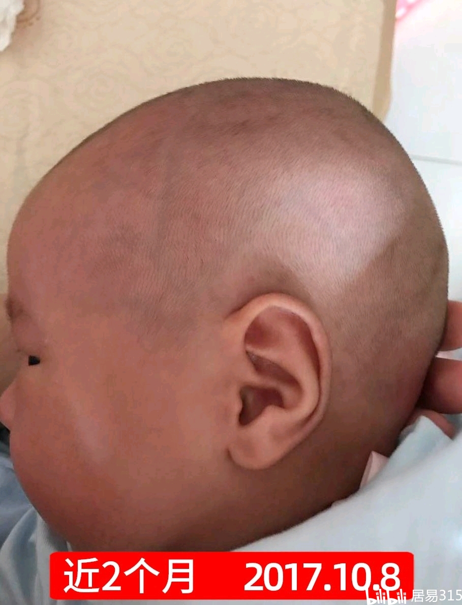 婴儿小圆头控颜术 | 近2个月宝宝尖头舟状头矫正头型实录